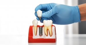 One-piece implants: benefits One-piece implants: benefits